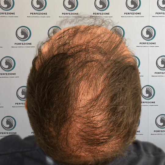tratamiento-capilar-estetica-clinica-alopecia-mujer-hombre-barcelona (5)