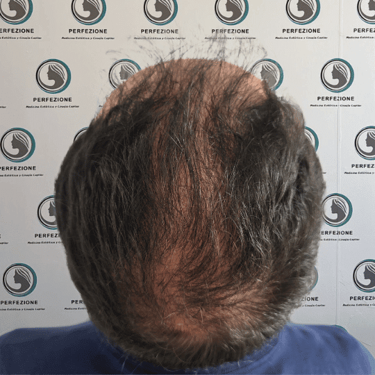 tratamiento-capilar-estetica-clinica-alopecia-mujer-hombre-barcelona (6)