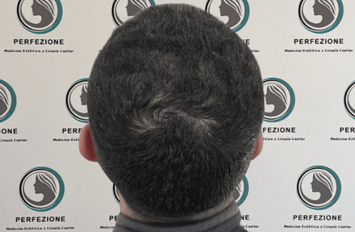tratamiento-con-neuromoduladores-botox-para-arrugas-de-expresion-y-rejuvenecimiento-facial-en-clinica-perfezione-madrid