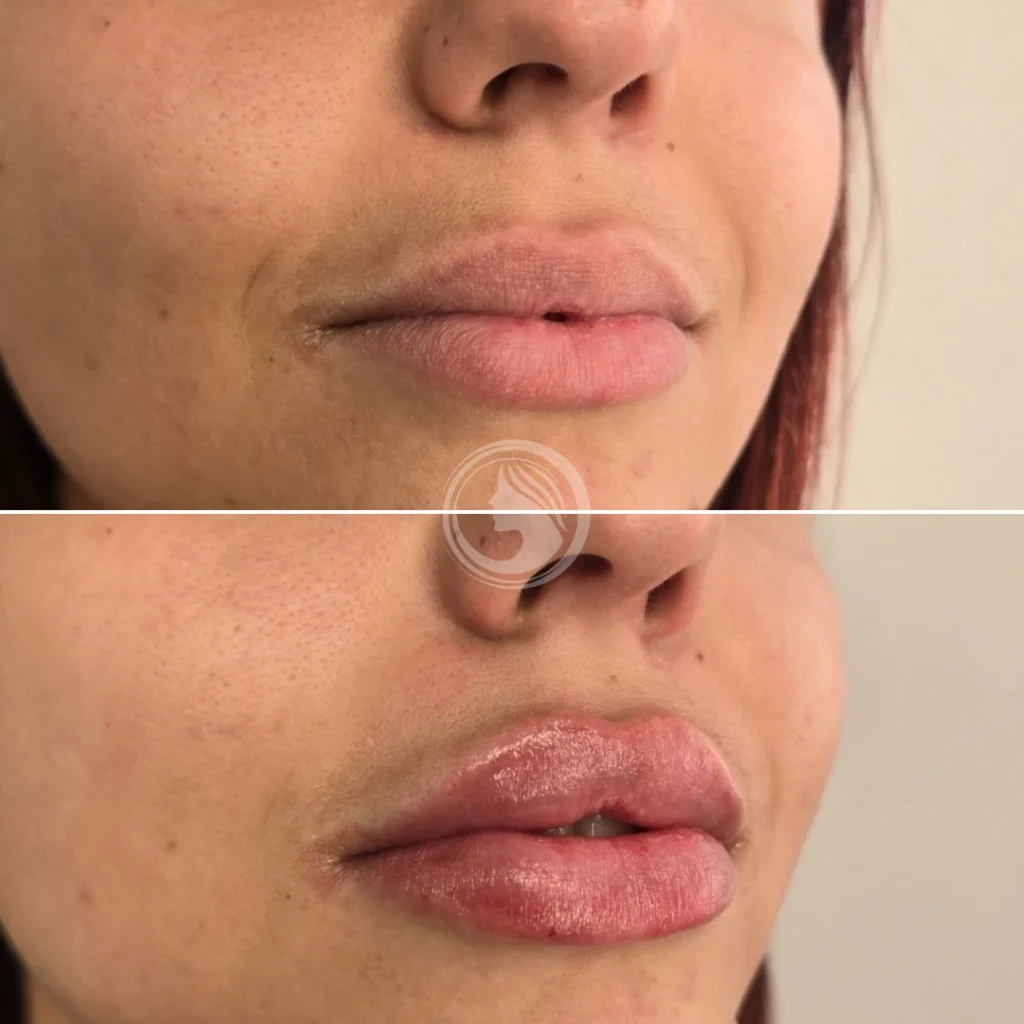 russian lips antes y despues clinica perfezione.webp