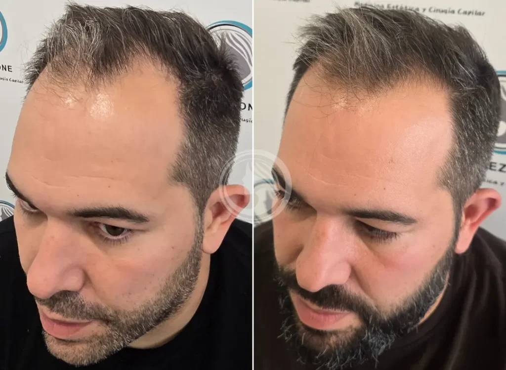 antes-despues-cellbooster-capilar-cabello-frontal-getafe-perfezione.webp