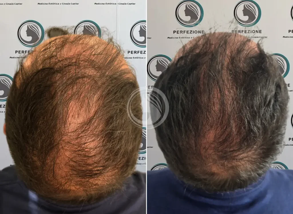 antes-despues-cellbooster-capilar-frontal-getafe-perfezione.webp