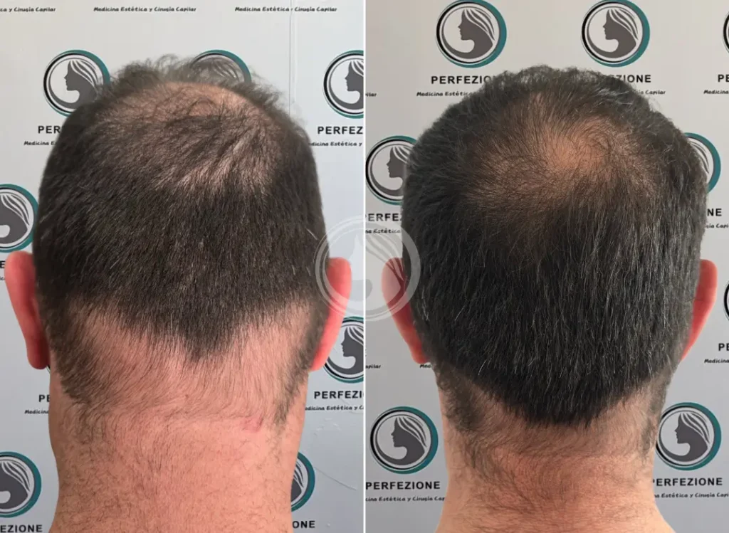antes-despues-cellbooster-vitaminas-hombre-mujer-getafe-perfezione.webp