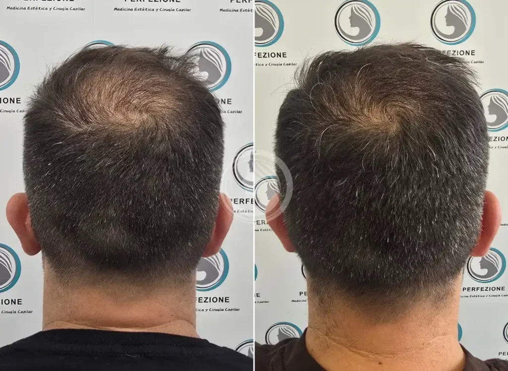 antes-despues-dutasterida-coronilla-capilar-getafe-perfezione.webp