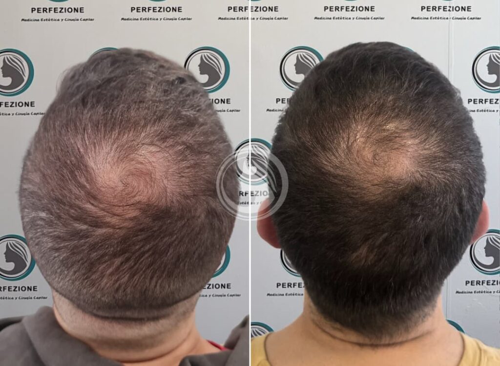 antes-despues-mesoterapia-cellbooster-getafe-perfezione.webp