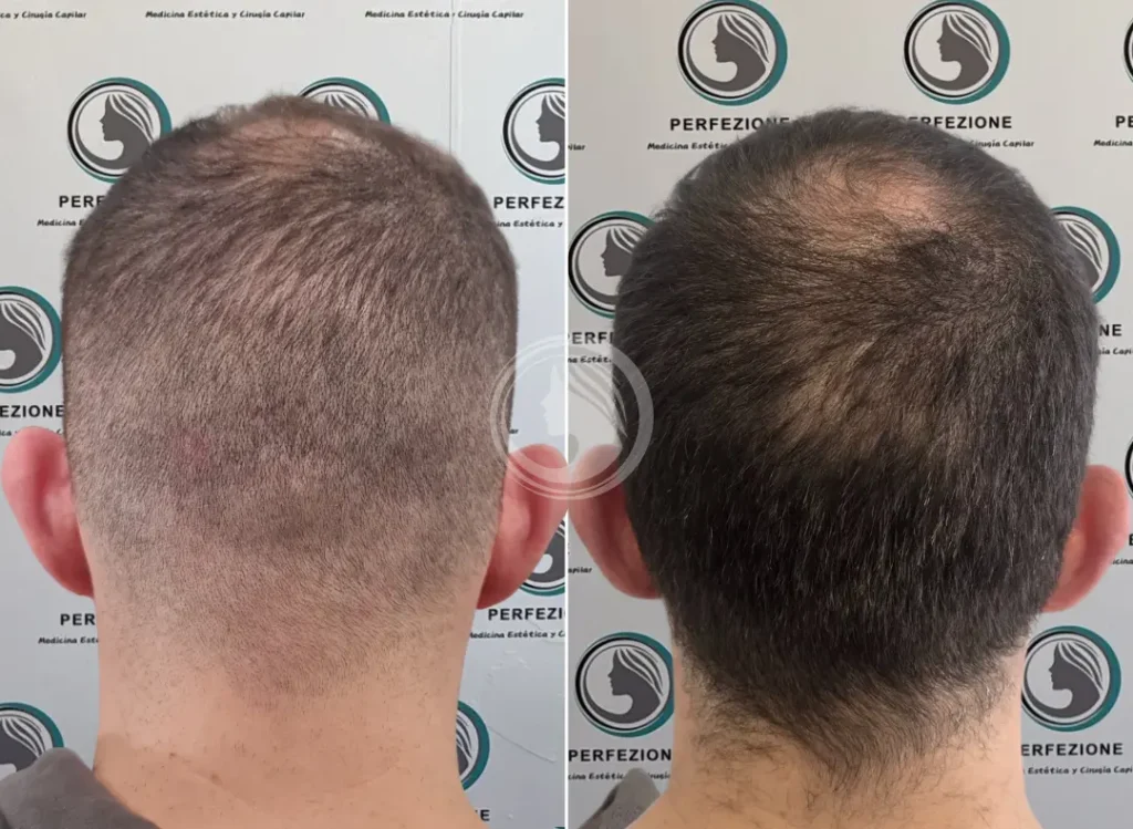 antes-despues-mesoterapia-cellbooster-getafe-perfezione.webp