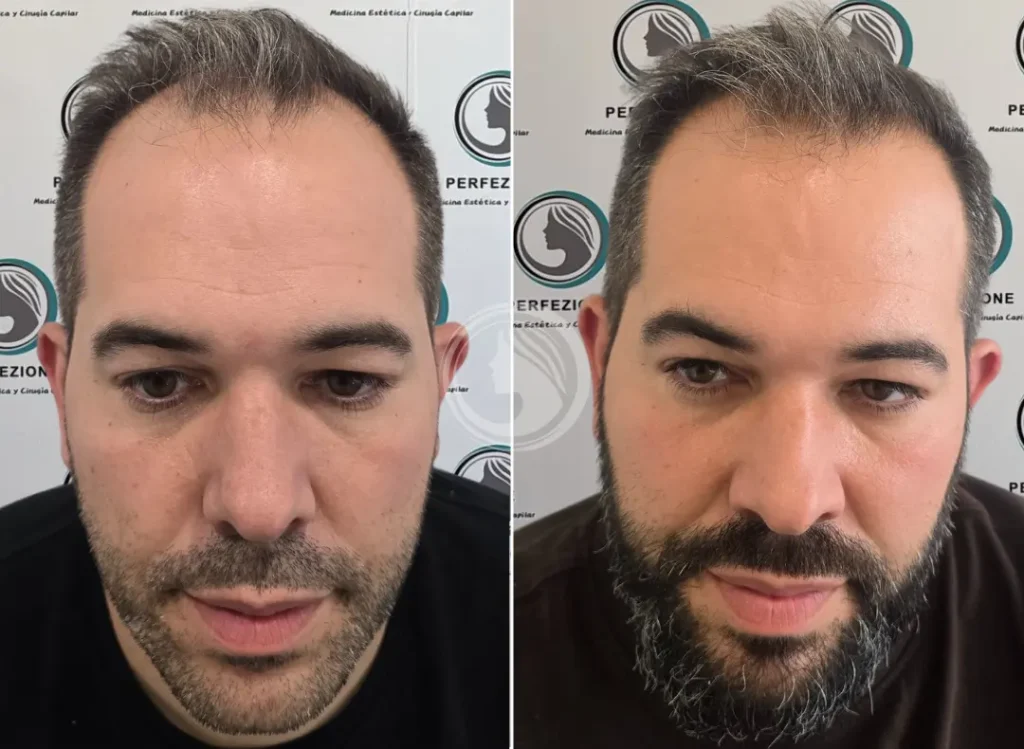 antes-despues-mesoterapia-dutasterida-getafe-perfezione.webp