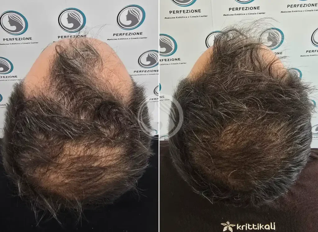 antes-despues-prp-coronilla-capilar-getafe-perfezione.webp