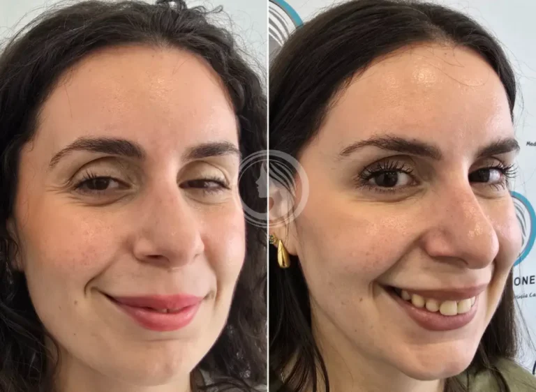 expresion-natural-tratamiento-neuromodulador.webp