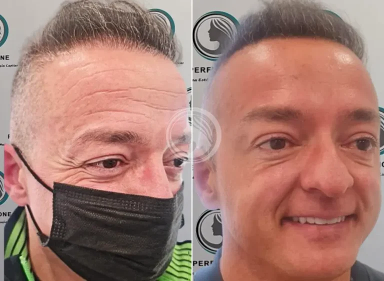 neuromodulador-muscular-perfezione-clinic-getafe.webp