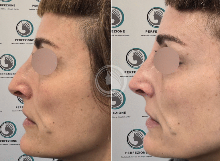 perfilado-nasal-acido-hialuronico.webp