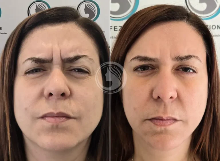 procedimiento-medico-neuromodulador-facial.webp