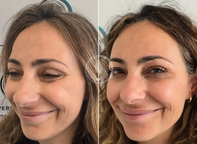 resultados-naturales-neuromodulador-facial.webp