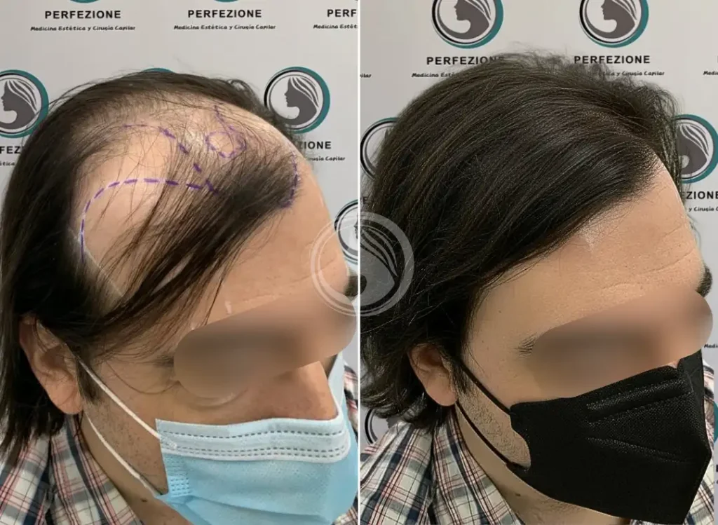 tratamiento-alopecia-getafe.webp