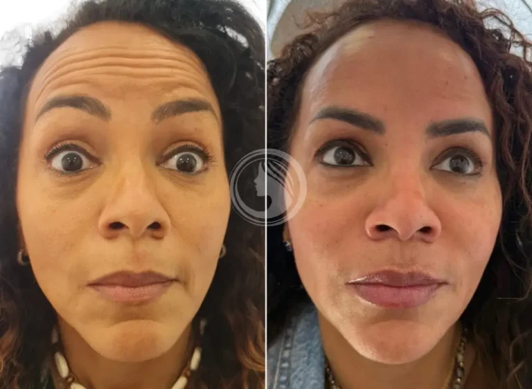 tratamiento-neuromodulador-facial-madrid.webp