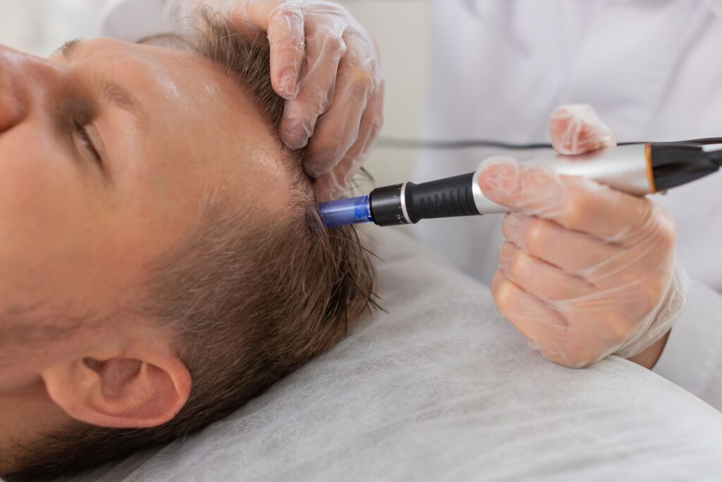La mesoterapia capilar