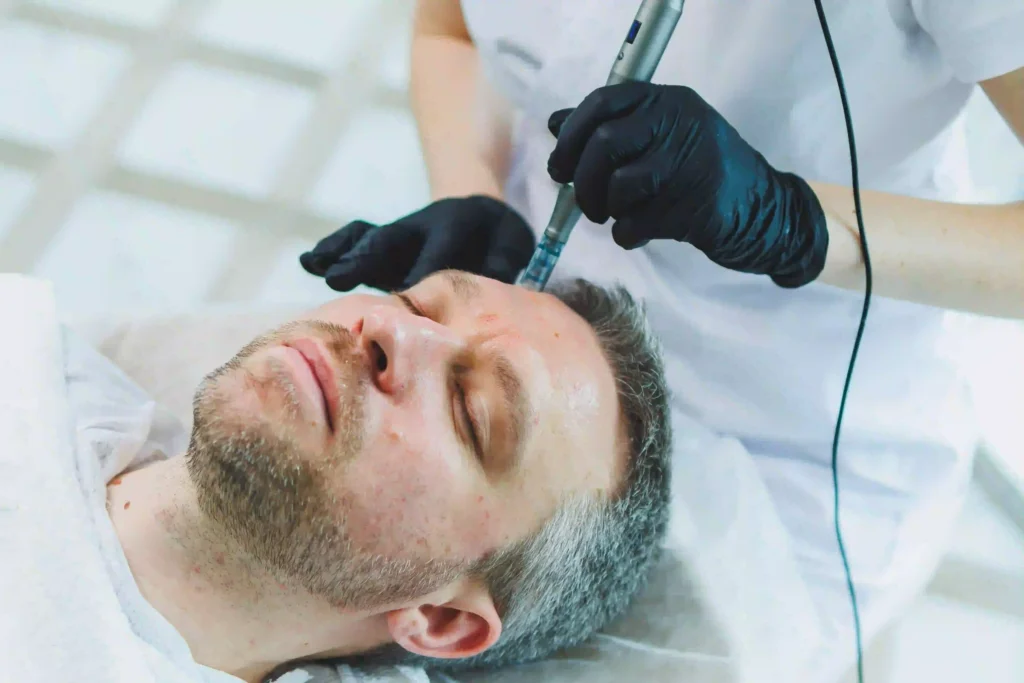 microneedling con dutasteride y exosomas para alopecia.webp scaled e1765046592202