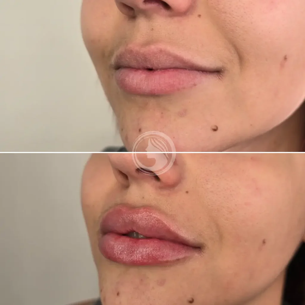 Resultados del relleno de labios Russian Lips: antes y después