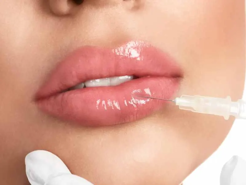 Russian Lips vs relleno de labios tradicional: diferencias clave