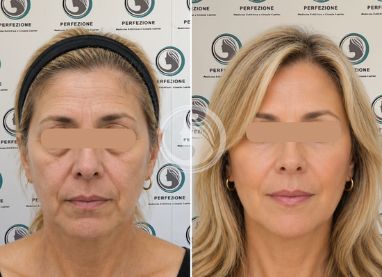 bioestimuladores colageno getafe madrid 1