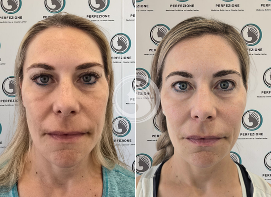 clinica estetica getafe bioestimulacion.webp