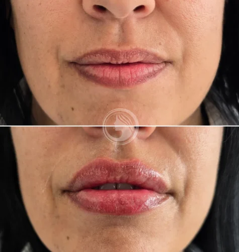 Antes y después de labios hidratados y definidos con técnica Russian Lips en Getafe.