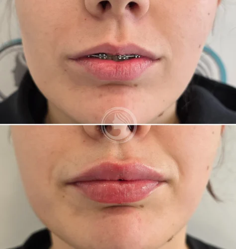 Aumento y definición de labios en Perfezione Clinic.