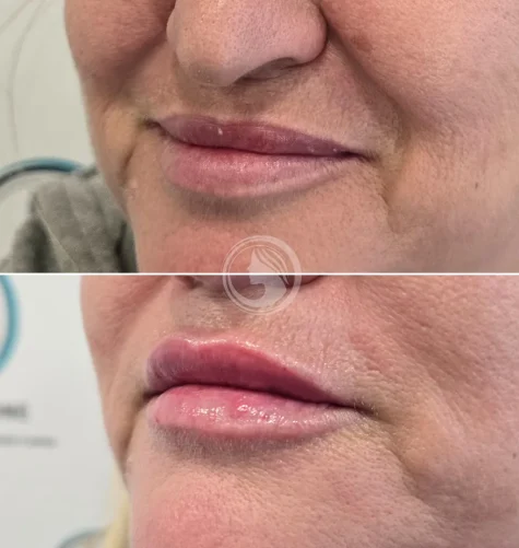 Labios con efecto lifting y mayor proyección.