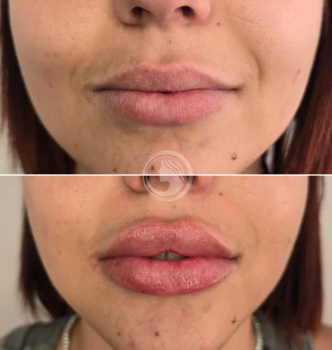 Resultado tras sesión de Russian Lips – volumen equilibrado.