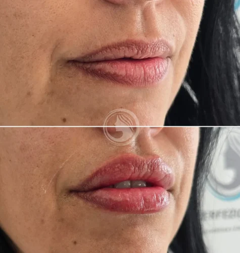 Antes y después del tratamiento de labios Russian Lips.