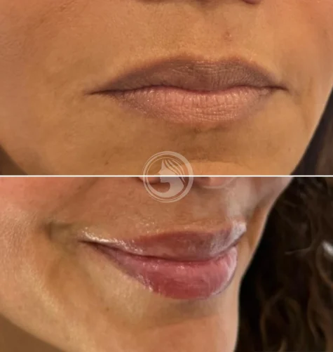 tratamiento-russian-lips-getafe-madrid.webp